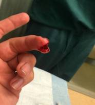 So My Friend Cut His Finger On A Band Saw. Check Out The Pics.